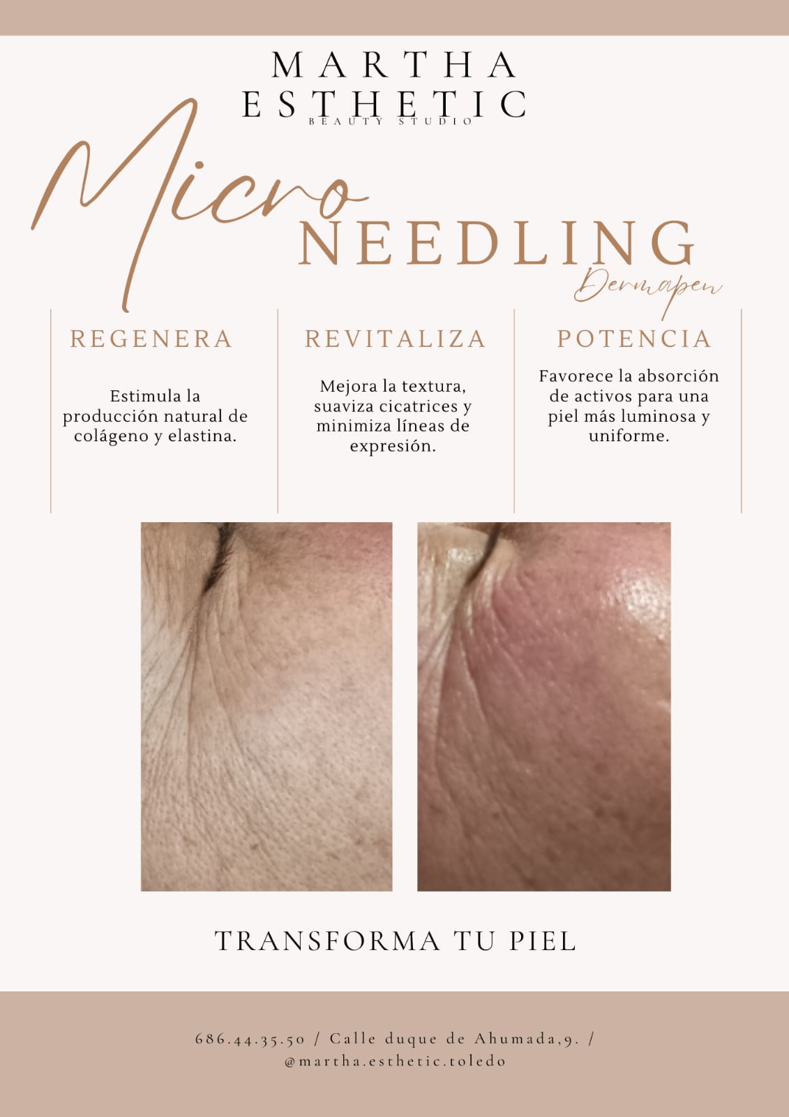 Microneedling